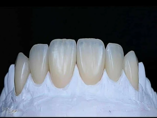 hollywood smile