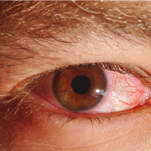 conjonctivite-infectieuse