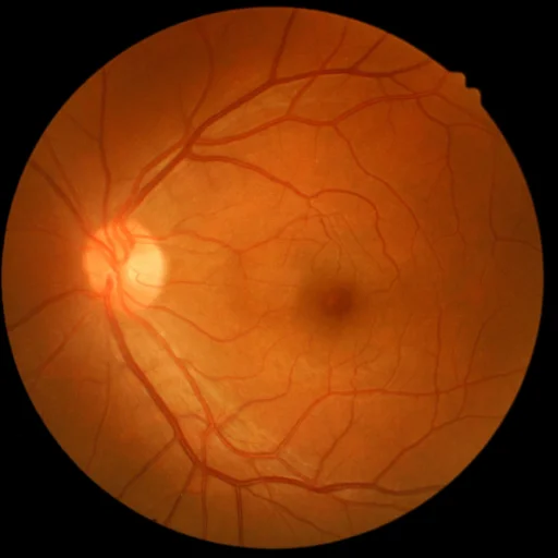 fibrose-premaculaire