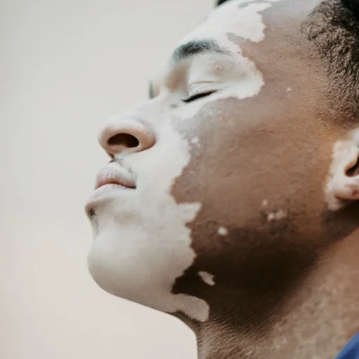 vitiligo