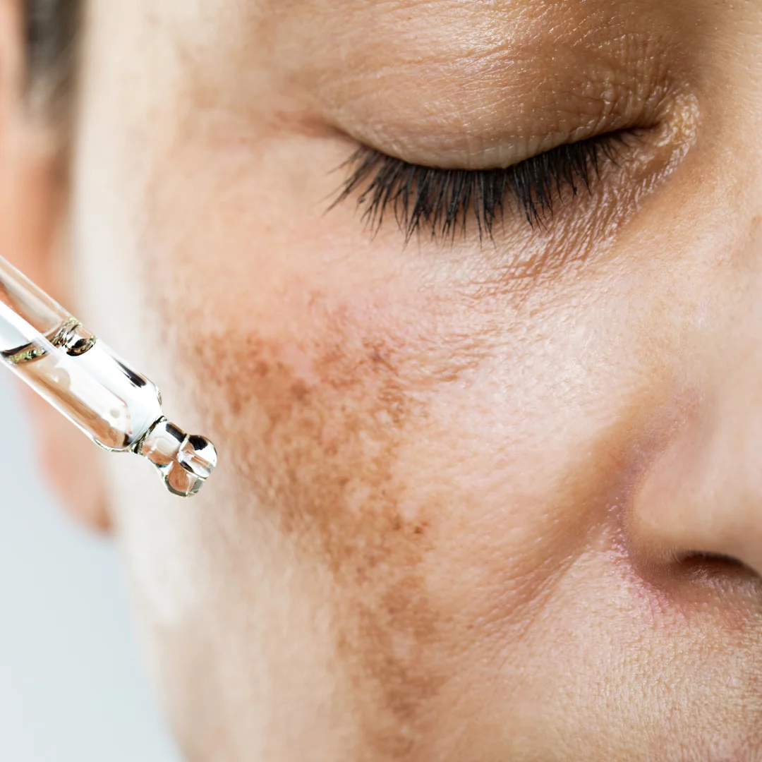 hyperpigmentation
