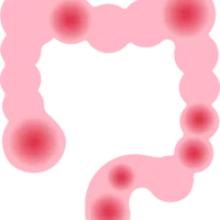 maladie-diverticulaire