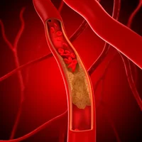maladies-des-vaisseaux-sanguins