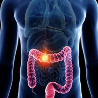 maladies-du-colon-et-du-rectum