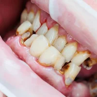 malformations-dentaires-et-maxillo-dentaires