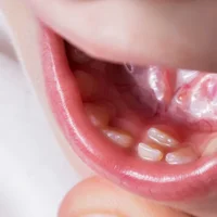 malformations-et-anomalies-dentaires