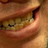 malocclusions-dentaires