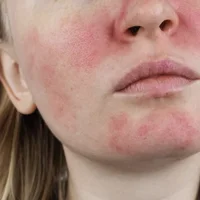 rougeurs-faciales