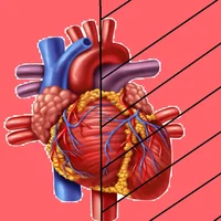 syndrome-du-coeur-gauche-hypoplasique