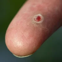 granulomes-pyogeniques