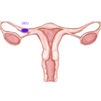 grossesse-extra-uterine