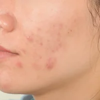 acne