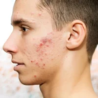 acne-inflammatoire