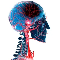 accident-vasculaire-cerebral-avc