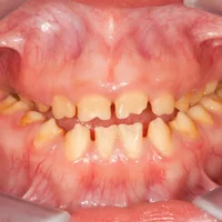 amelogenese-imparfaite