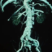 anevrismes-aortiques