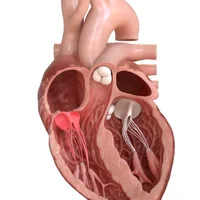 incompetence-tricuspidienne