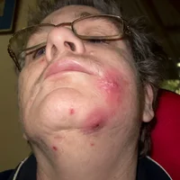 infection-a-staphylococcus