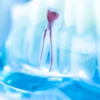 infection-de-la-racine-dentaire