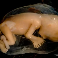 infection-intra-amniotique