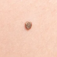 carcinome-epidermoide