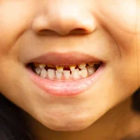caries-dentaires-chez-les-enfants