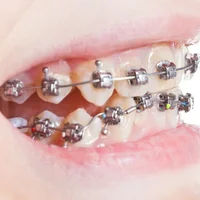 defauts-de-lalignement-dentaire