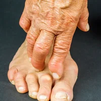 deformation-en-col-de-cygne