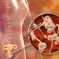 infection-vaginale-a-levures-candidose