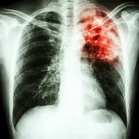 infections-apparentees-a-la-tuberculose