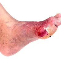 infections-du-pied-chez-les-personnes-diabetiques
