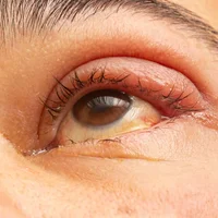 infections-oculaires