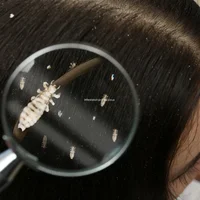 infestation-par-les-poux