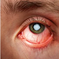 inflammation-de-la-cornee