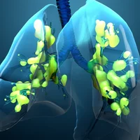 insuffisance-respiratoire-aigue