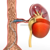 embolie-gazeuse-arterielle