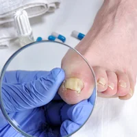 dystrophie-des-ongles