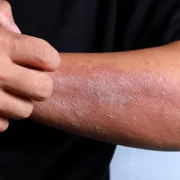 eczema