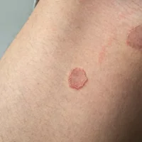 eczema-margine-de-hebra-lintertrigo-inguinal