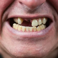 edentement-partiel-ou-complet