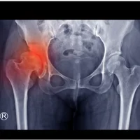dysplasie-developpementale-de-la-hanche