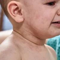 roseole-exantheme-subit