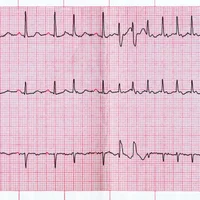 extrasystoles-auriculaires