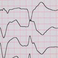 extrasystoles-ventriculaires