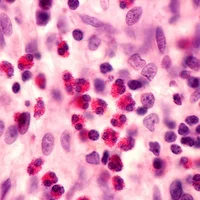 fasciite-a-eosinophiles