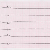fibrillation-ventriculaire
