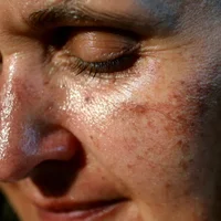 lesions-pigmentaires-taches-brunes