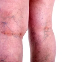 lesions-vasculaires-varicosites