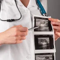 fibroadenomes-mammaires