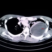 fibroelastose-pleuroparenchymateuse-idiopathique